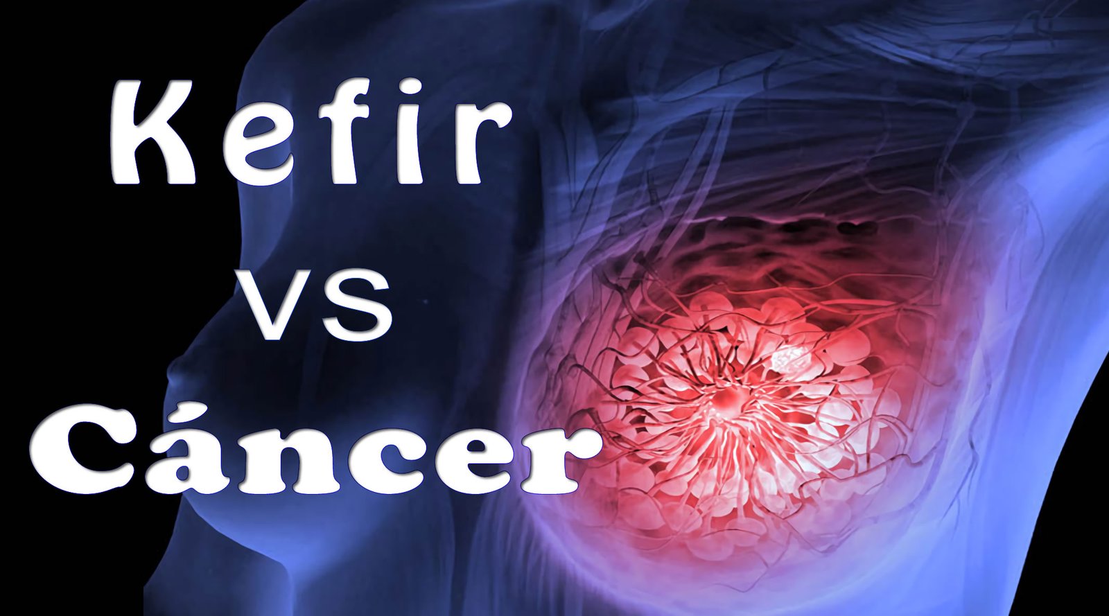 cáncer de mama