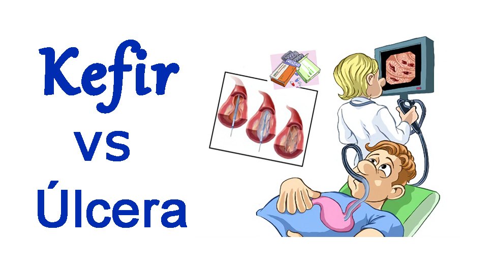 úlcera péptica